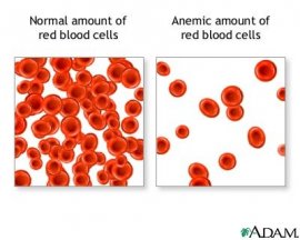 anemia