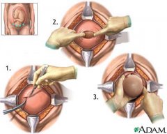 Nursing Diagnosis for Cesarean section (C-section)