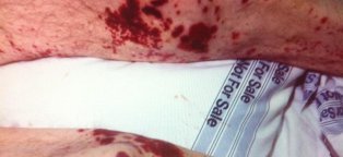 Nursing - blanchable Skin